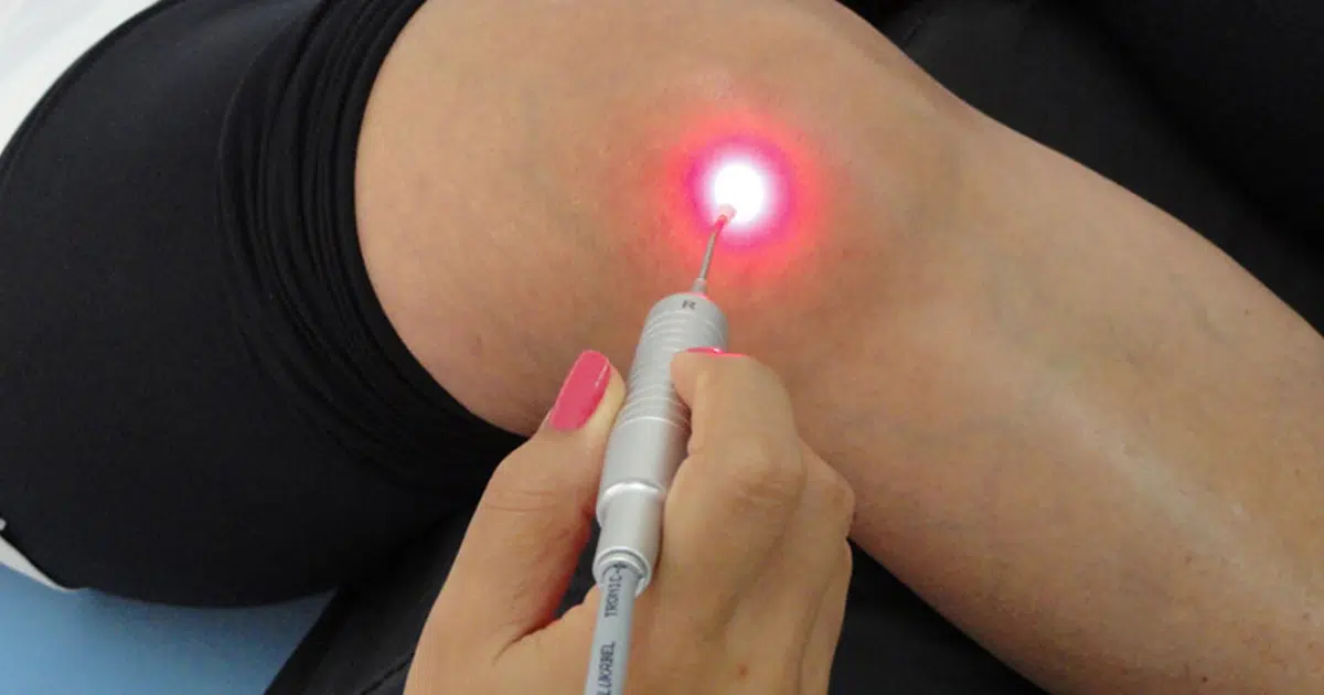 Benefícios da laserterapia no tratamento de feridas