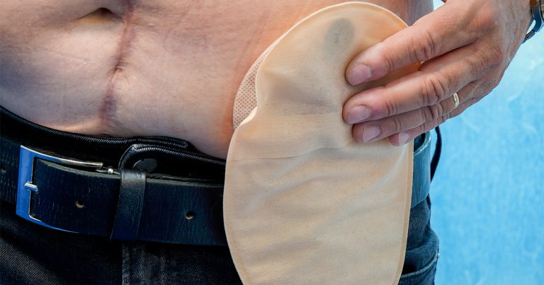 Conheça 9 fatos sobre a colostomia