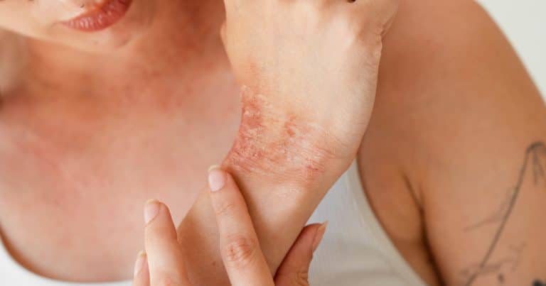 O Enfermeiro Estomaterapeuta no Atendimento Integral às Pessoas Vítimas de Queimaduras