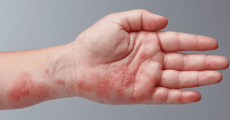 Outubro: Mês da Conscientização da Epidermólise Bolhosa