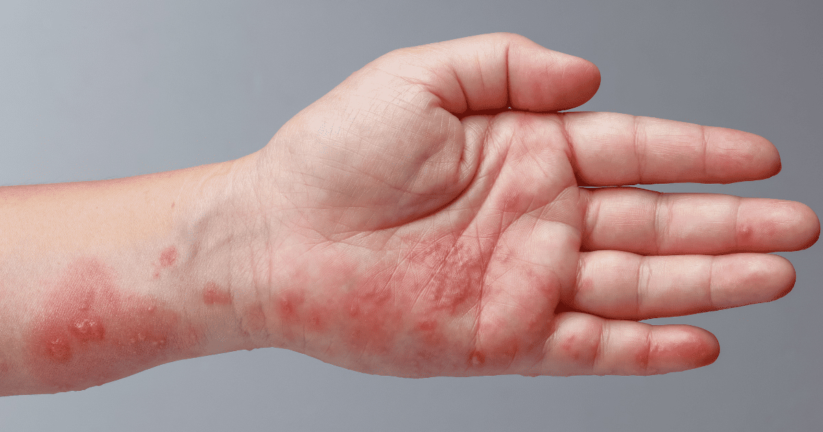 Outubro: Mês da Conscientização da Epidermólise Bolhosa