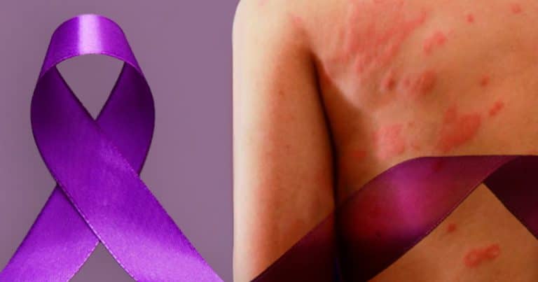 Janeiro Roxo: Hanseníase e Diagnóstico Precoce